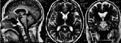 Parkinsonismos: Variantes, Diferencias y Mejora de Calidad de Vida